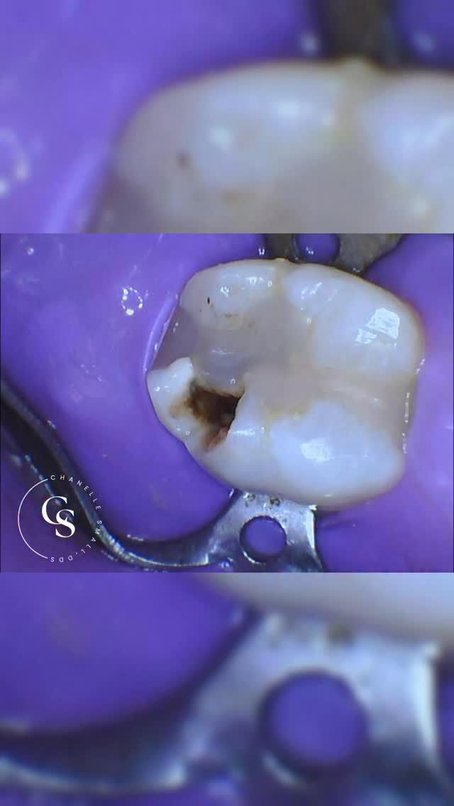 can you smoke cigarettes after a root canal Can You Smoke After a Root Canal? Everything Want You to Know