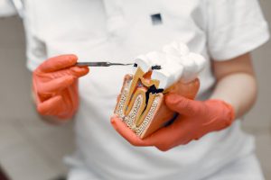root canal new york city